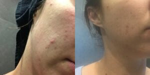 Clear Skin Pack for Oily & Acne-Prone Skin