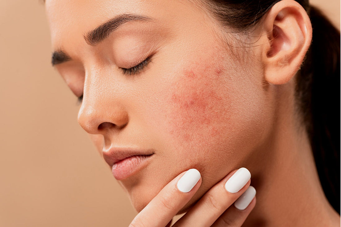 How Manuka Honey Helps For Acne