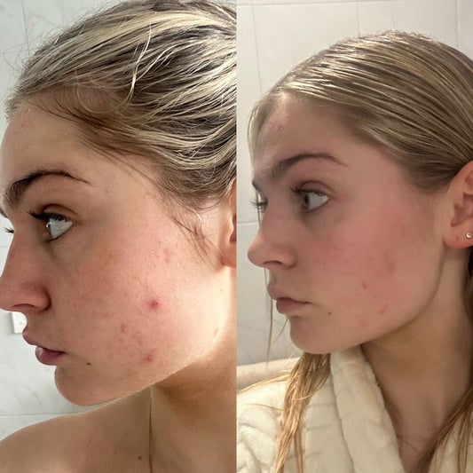 Clear Skin Pack for Oily & Acne-Prone Skin
