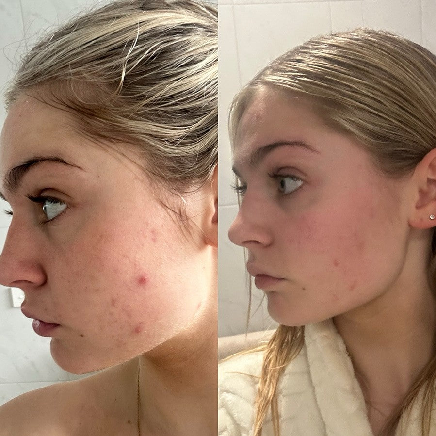 Clear Skin Pack for Oily & Acne-Prone Skin